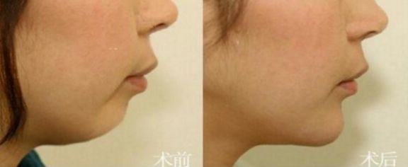 成都這7家專業(yè)豐胸醫(yī)院，不可錯過的排名第一