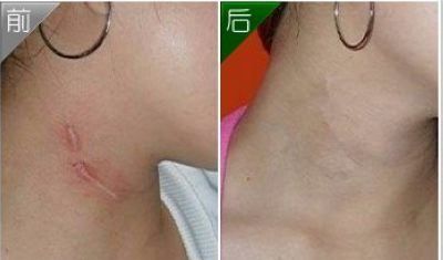 廣州隆胸手術(shù)費(fèi)用及案例分享，口碑如何？