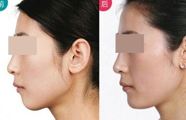 上海哪個醫(yī)生擅長鼻翼縮??？2023年度網(wǎng)民口碑推薦醫(yī)生名冊曝光