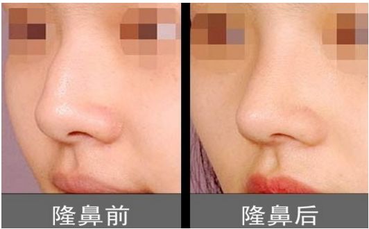 上海柴云醫(yī)生雙眼整形效果完美！手術(shù)前后真實照片呈現(xiàn)出專業(yè)水平