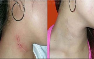 北京首都整形醫(yī)院雙眼皮修復效果如何？詳細案例揭秘
