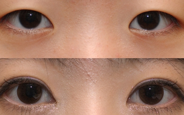 上海哪家醫(yī)院做眼袋手術(shù)價格實(shí)惠又靠譜？排行榜前十強(qiáng)！