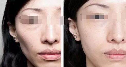 注射隆鼻，需要了解的材料有哪些？
