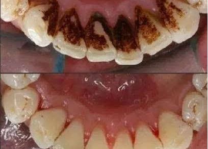 上海蝶可變整形醫(yī)院豐胸案例新鮮發(fā)布，引領(lǐng)時尚潮流