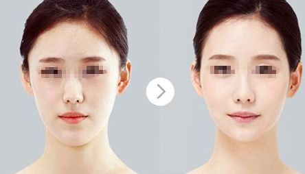 內(nèi)蒙古呼和浩特填充硅膠隆鼻有何獨(dú)特之處？五種整形手術(shù)方式綜合對比！