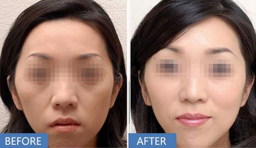 上海哪家醫(yī)院做打玻尿酸除皺效果好？