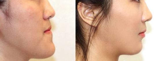 南京施爾美醫(yī)院醫(yī)生案例對比，讓你信服！