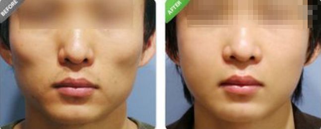 深圳哪家醫(yī)院的拉皮除皺效果最好？排名前幾位的醫(yī)院有哪些？