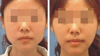 上海哪家醫(yī)院的下巴隆鼻手術(shù)效果最好？