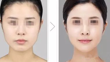 長(zhǎng)沙雙眼皮整形醫(yī)院推薦，哪家效果更好？