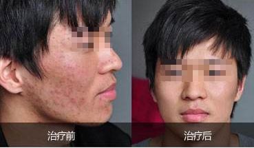 重慶吸脂哪家好？華美吸脂專(zhuān)家經(jīng)驗(yàn)豐富，安全保障