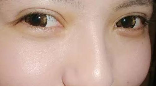 面對(duì)魚尾紋問題，該怎么辦？