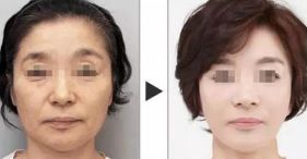 西安哪家醫(yī)院擅長面部輪廓整形？