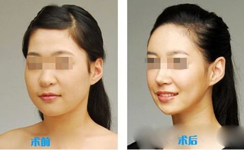 肌功能矯治，哪個階段適合兒童早期干預？哪些醫(yī)院堪稱專家？