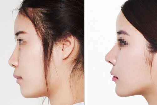 汕頭名流整形醫(yī)院：拉雙眼皮、吸脂價(jià)格一覽，專家解讀真實(shí)案例