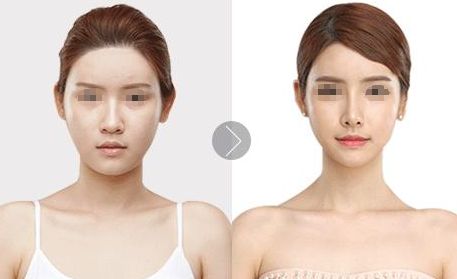 北京植發(fā)醫(yī)院推薦，哪家效果好？