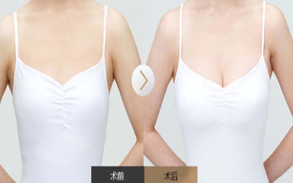 上海做內(nèi)切眼袋手術醫(yī)生