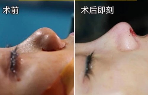 杭州哪家醫(yī)院是面部吸脂的佼佼者？推薦前六強公&私立醫(yī)院，讓您選到心儀的！
