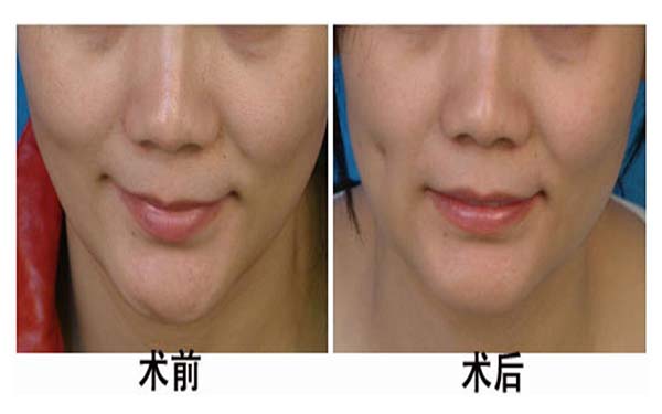 湖州雙眼皮手術(shù)機(jī)構(gòu)推薦：3家優(yōu)質(zhì)醫(yī)院完美整形，放心選擇