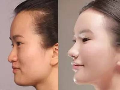 2023年，哪些上海自體脂肪面部精雕整形醫(yī)院的口碑特別好？排名榜前十值得信賴的美容整形醫(yī)院！