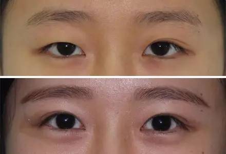 杭州駝峰鼻矯正哪家整形醫(yī)院技術(shù)獨(dú)特？2023杭州駝峰鼻矯正排名前10的醫(yī)院評(píng)測(cè)揭曉！