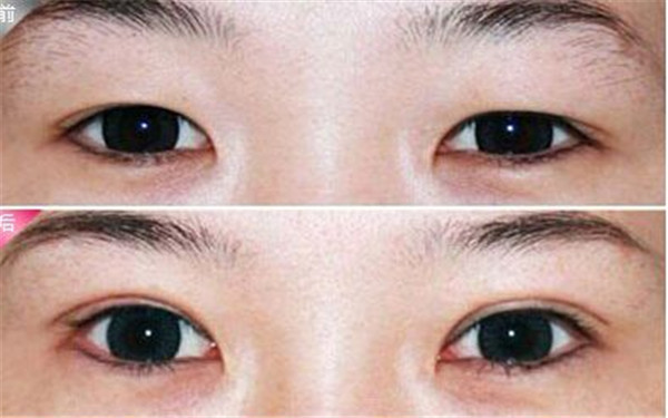 杭州哪家整形醫(yī)院效果好，專業(yè)解決祛痘坑痘印問題，2023很受歡迎的前十家！