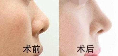 昆山顴弓肥大整形美容醫(yī)院哪些較為權(quán)威？2023昆山顴弓肥大專(zhuān)科醫(yī)院綜合排行榜前十大分享！