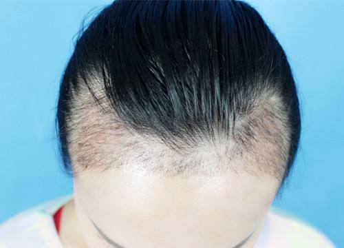 宜賓市哪家整形醫(yī)院專業(yè)豐額頭術(shù)效果好？探尋宜賓自體脂肪豐額頭術(shù)醫(yī)院口碑佳！2023宜賓豐額頭術(shù)推薦前十技