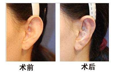 《長(zhǎng)春假體隆胸變軟最佳醫(yī)院排名TOP3解析》