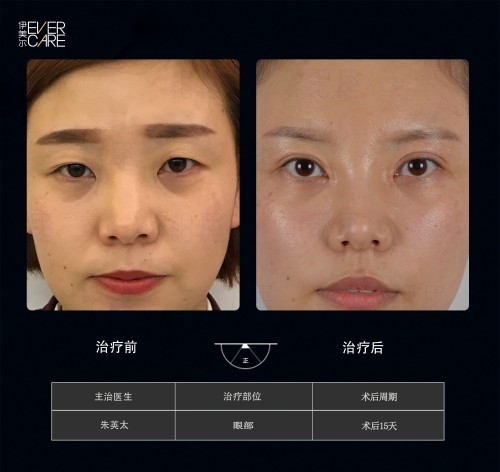 阿爾法9°美眼，打開視界，美無(wú)止境