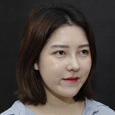 廣州美恩半肋鼻手術(shù)恢復(fù)效果反饋，主任親自操刀的效果就是贊！