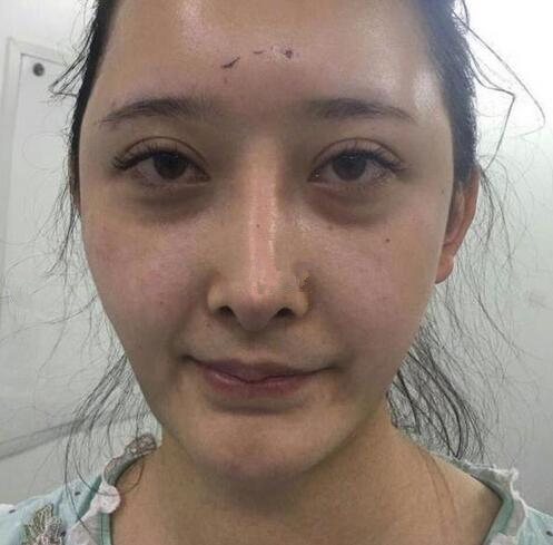 深圳陽光全臉填充術前術后對比，說年輕十歲不過分吧