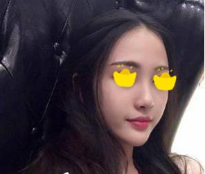 塌鼻子小妹在深圳鵬愛做隆鼻手術(shù)，三個月后竟然是這樣的