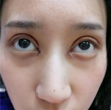 雙眼皮失敗丑的不敢見人，昆明麗都整形雙眼皮修復案例分享
