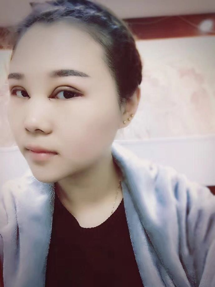 腫眼泡應該做哪種雙眼皮？汕頭曙光雙眼皮三個月效果分享