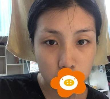 救命，周杰群做的耳軟骨隆鼻恢復(fù)后鼻背線條也太好看了吧