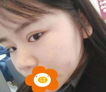 據(jù)說(shuō)杭州薇琳隆鼻后效果很自然，有案例嗎