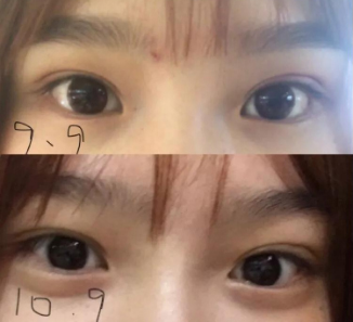 做雙眼皮案例，濟(jì)南坤如瑪麗崔金珍雙眼皮案例圖片