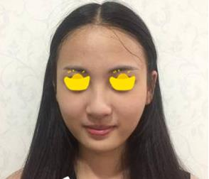 塌鼻子小妹在深圳鵬愛做隆鼻手術(shù)，三個月后竟然是這樣的