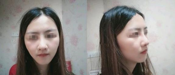濱州醫(yī)學(xué)院附屬醫(yī)院做隆鼻一個月效果
