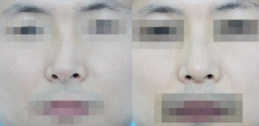 不要被營銷號帶偏了，鼻骨矯正其實很簡單