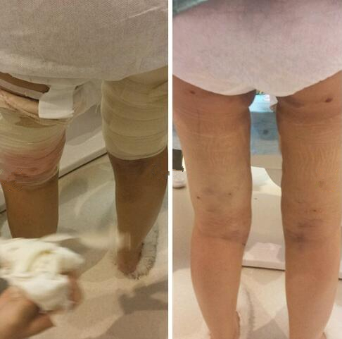 4800做的大腿吸脂，效果竟然還不錯