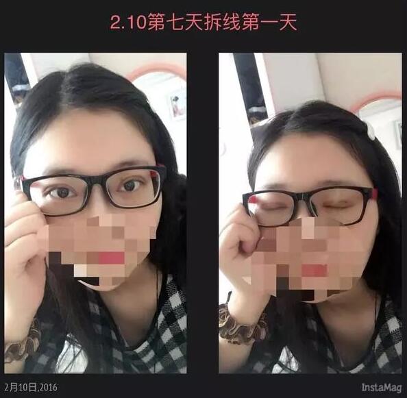 北京京民雙眼皮修復案例術后拆線效果