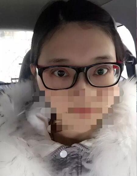 北京京民雙眼皮修復案例術前效果