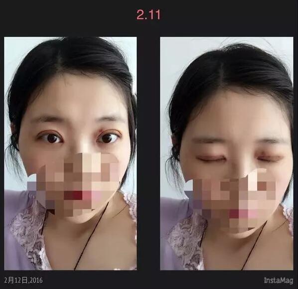 北京京民雙眼皮修復案例拆線后第二天