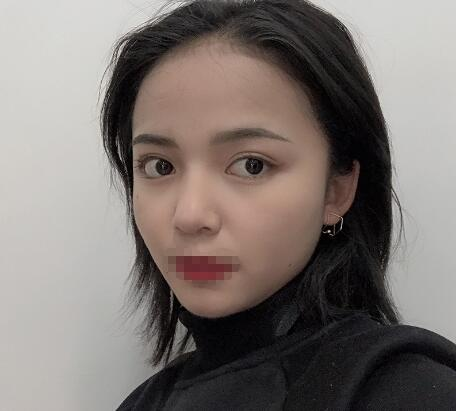 長沙愛思特整形定點雙眼皮案例分享，蘿莉到御姐的轉(zhuǎn)變