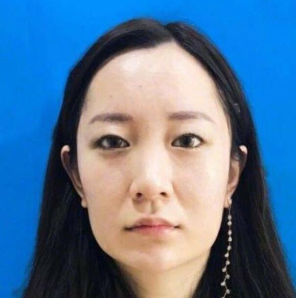 上海藝星整形崔海天下頜角整形術前效果