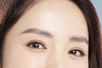衡陽(yáng)愛思特醫(yī)療美容醫(yī)院開眼角術(shù)后效果