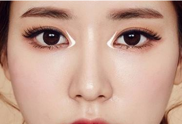 江門(mén)僑都華美整形美容醫(yī)院開(kāi)內(nèi)眼角