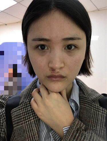 濟南鵬愛整形醫(yī)院怎么樣？濟南鵬愛王飏隆鼻案例分享